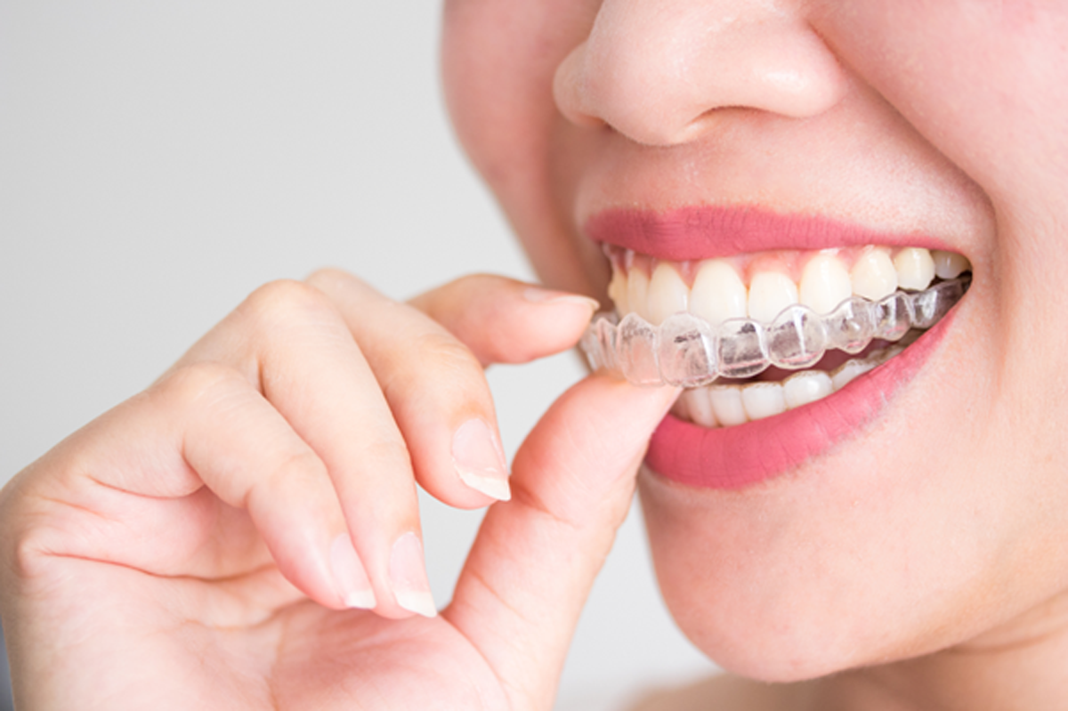 Lady wearing adult braces / clear aligners